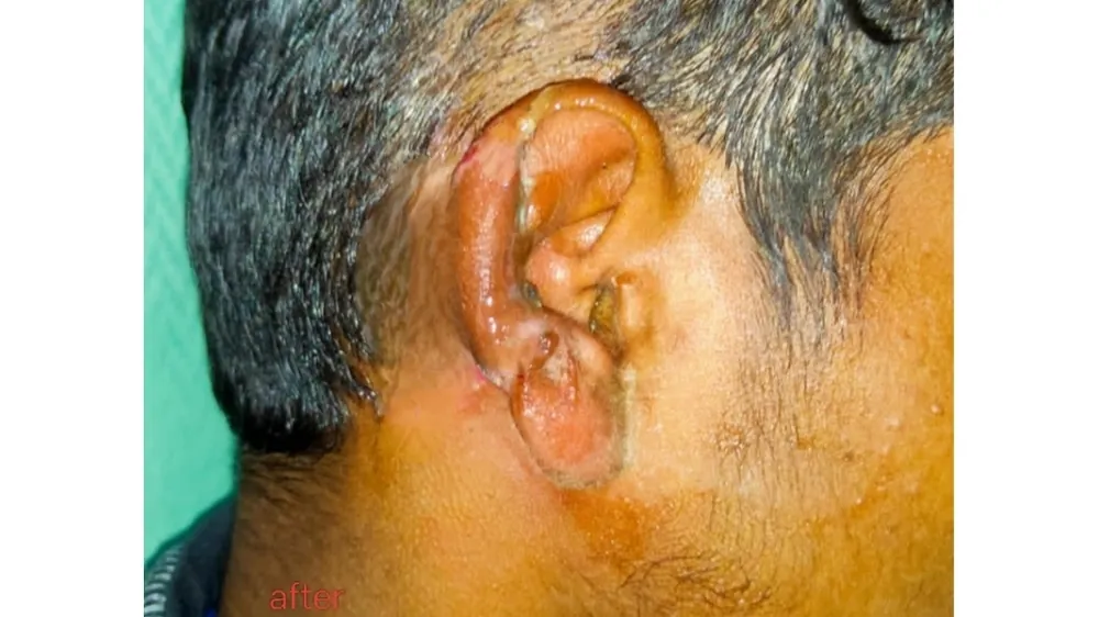 After surgery