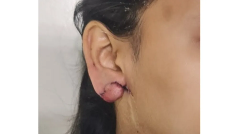 Ear Lobe Repair — after