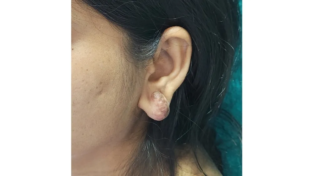 Ear Lobe Repair — before