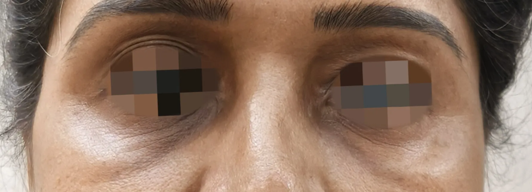 Blepharoplasty — before