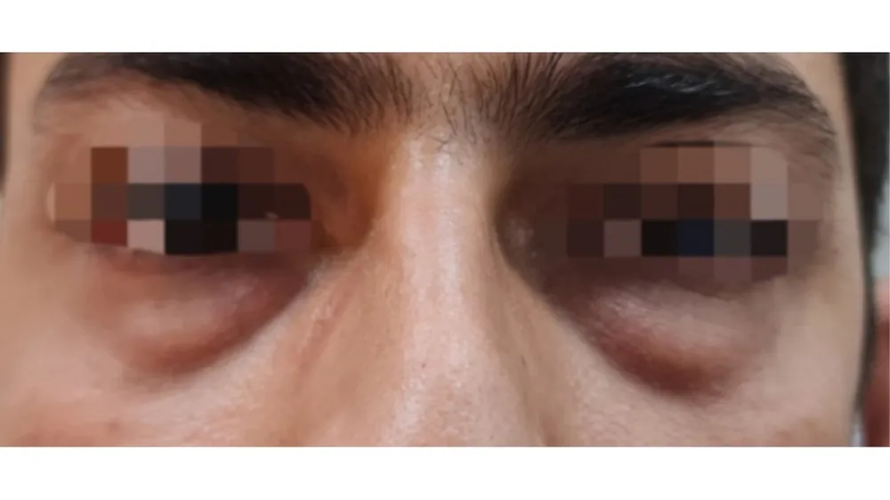 Blepharoplasty — before