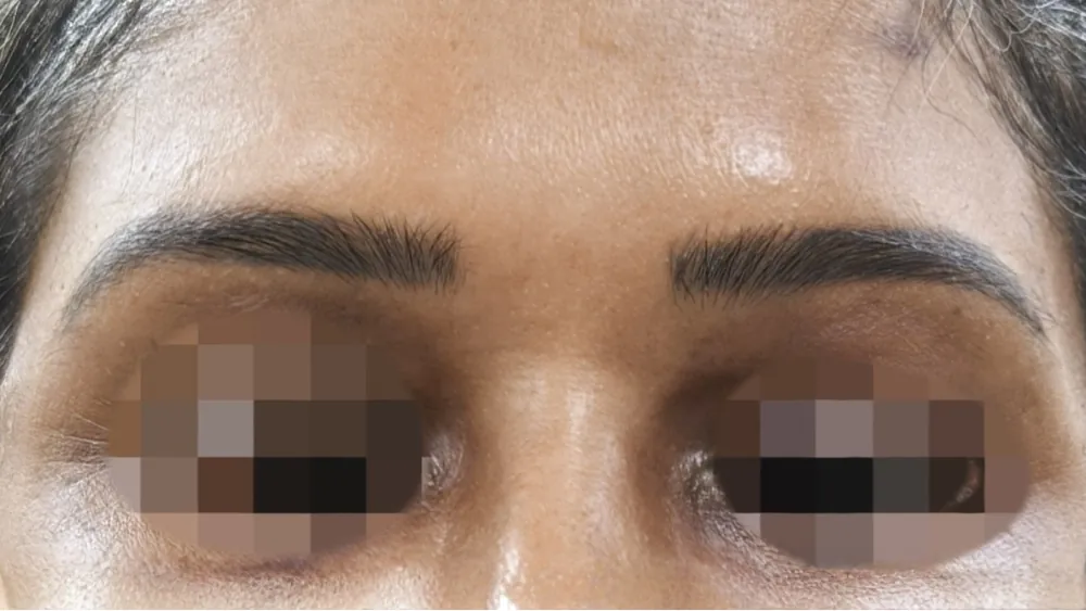 Brow Lift — after