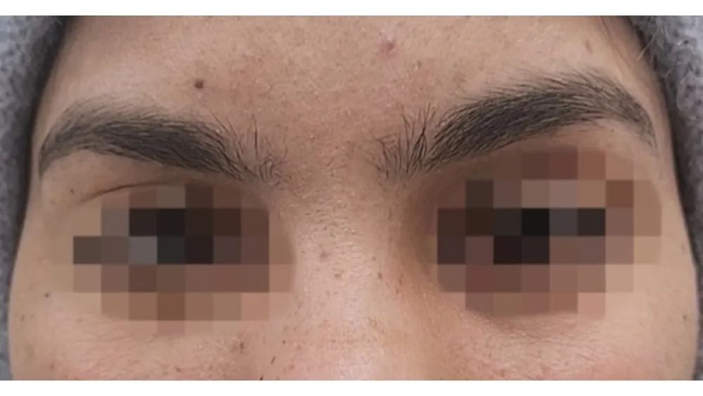 Brow Lift — after