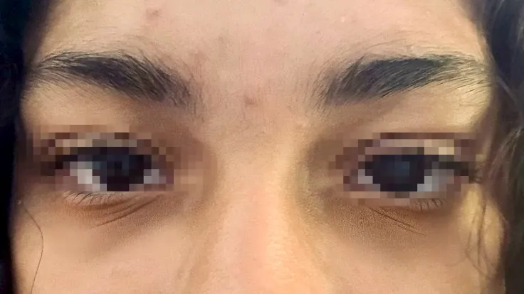 After surgery