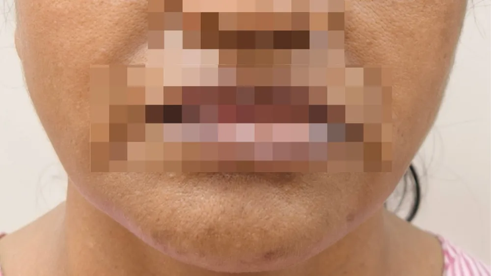 Before surgery