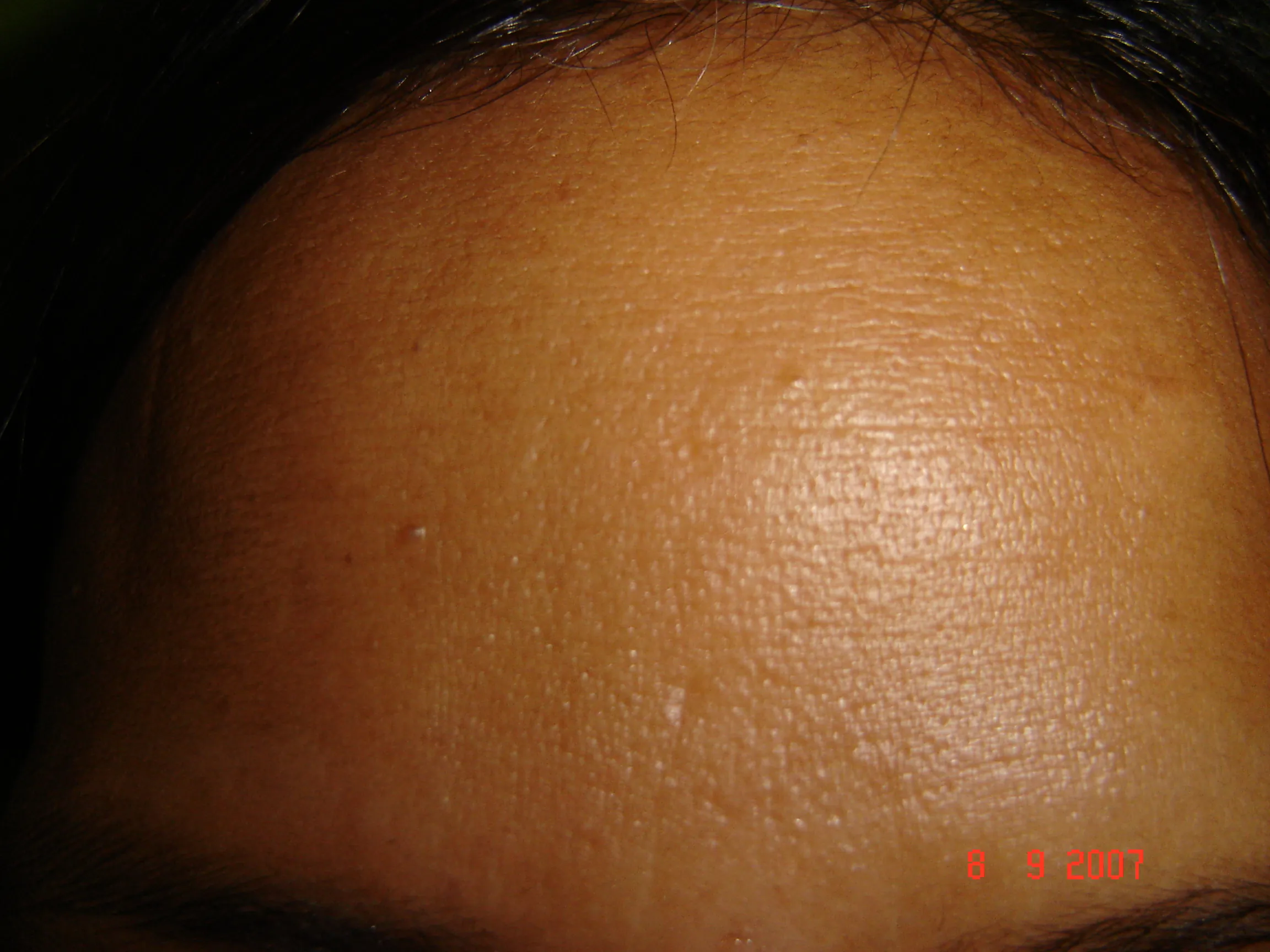 Facial Wrinkles — after