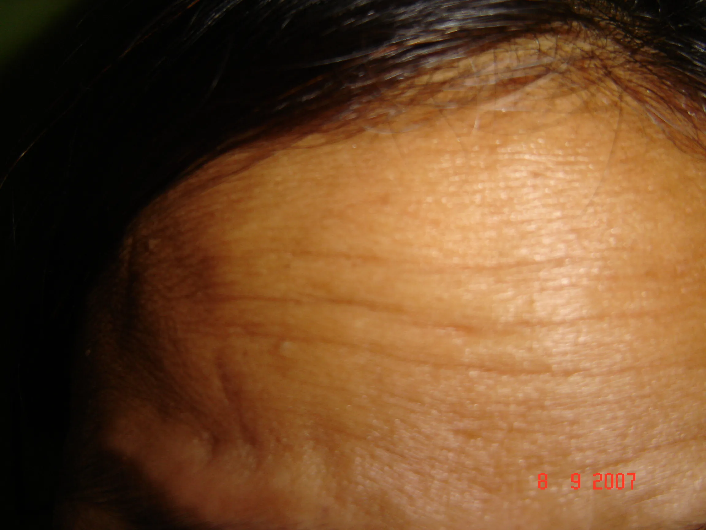Facial Wrinkles — before