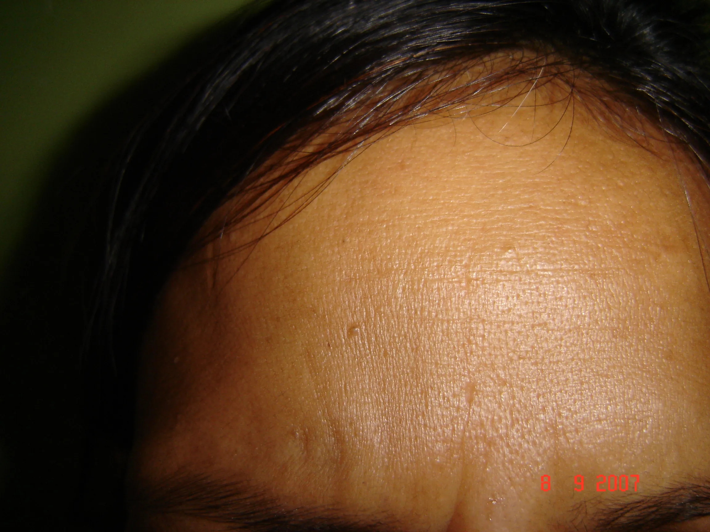 Facial Wrinkles — after