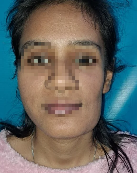 After surgery
