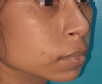 Before surgery