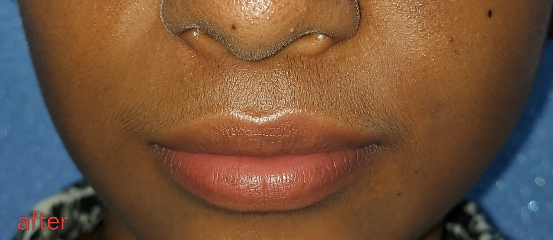 After surgery