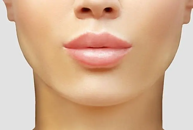 Upper Lip Lift — hero image
