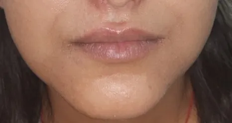 After surgery