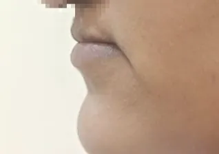 Before surgery