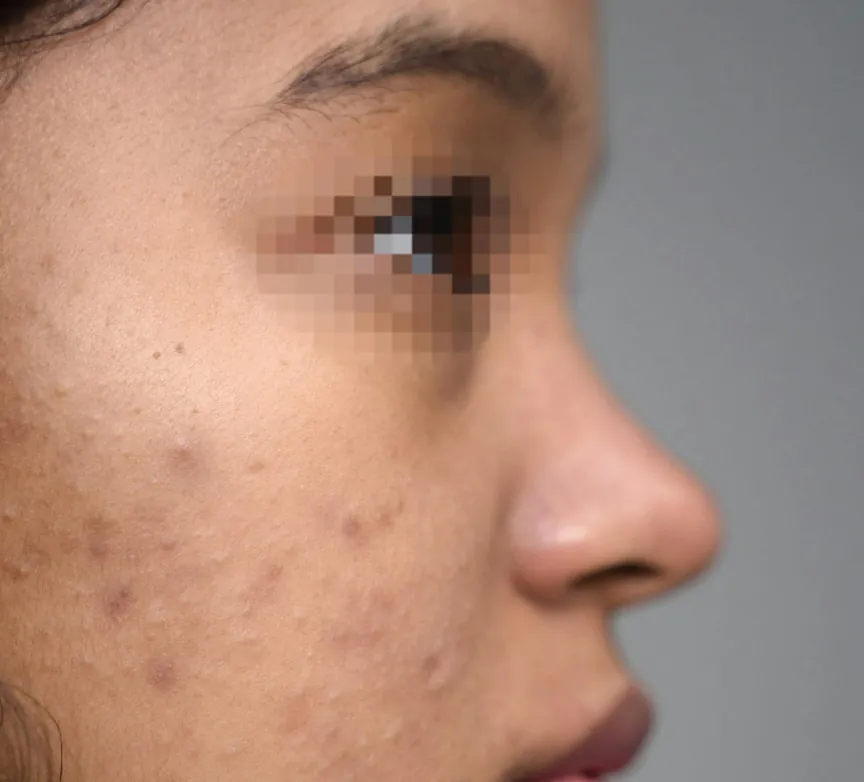 Non Surgical Rhinoplasty — after