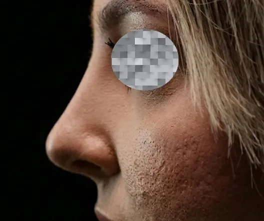 Non Surgical Rhinoplasty — after
