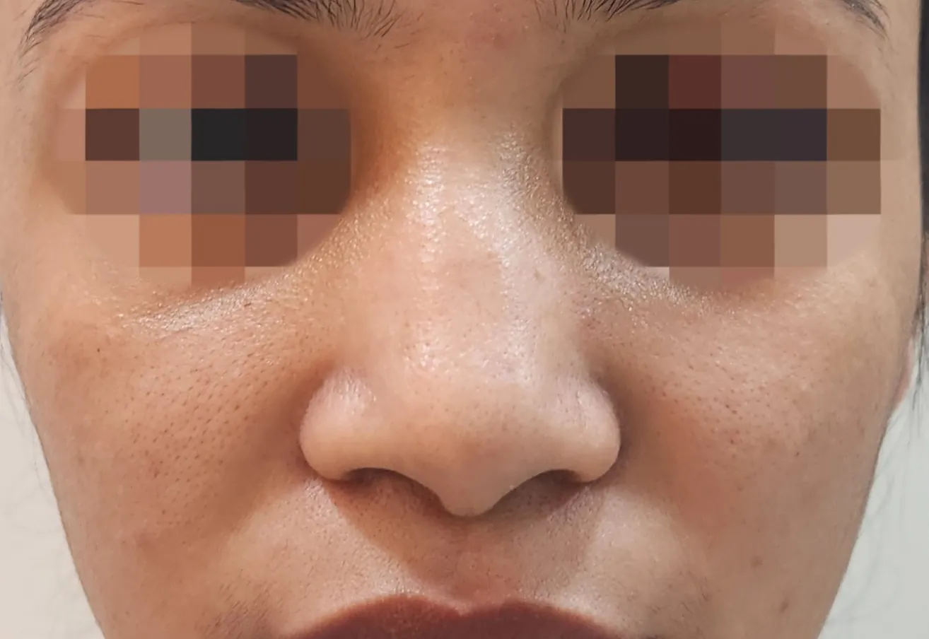 Non Surgical Rhinoplasty — after
