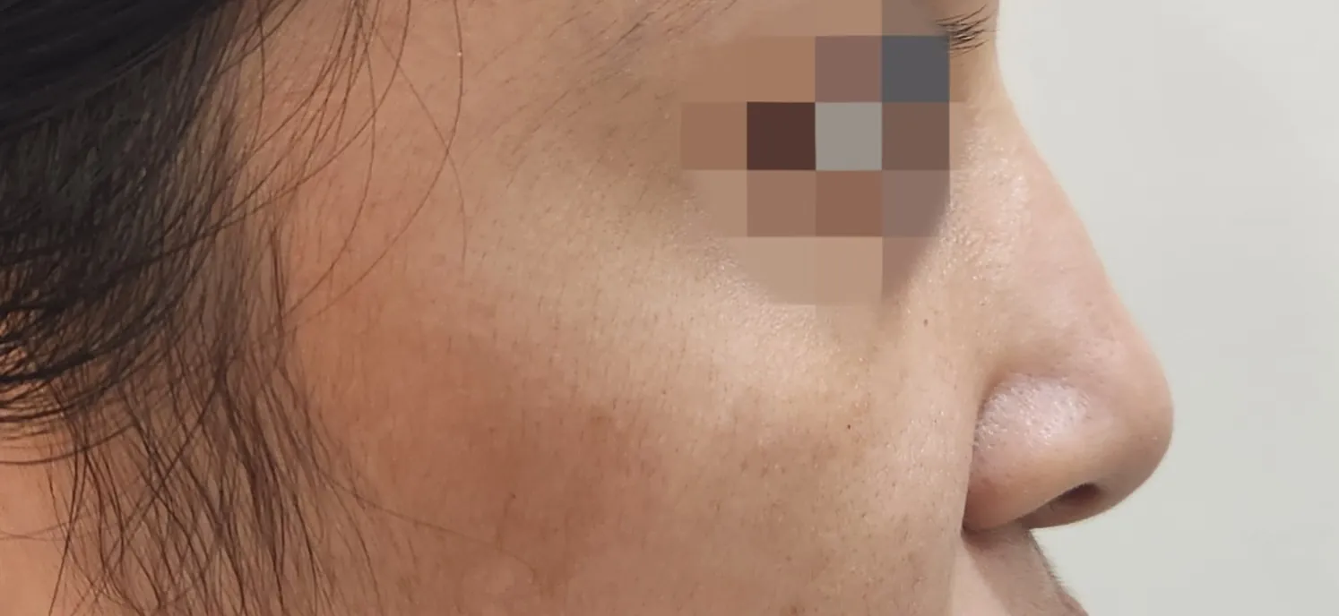 Non Surgical Rhinoplasty — after