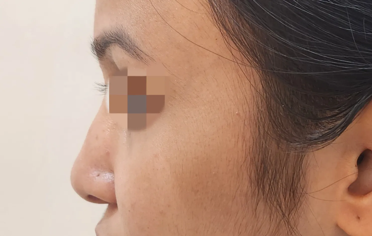 Non Surgical Rhinoplasty — after