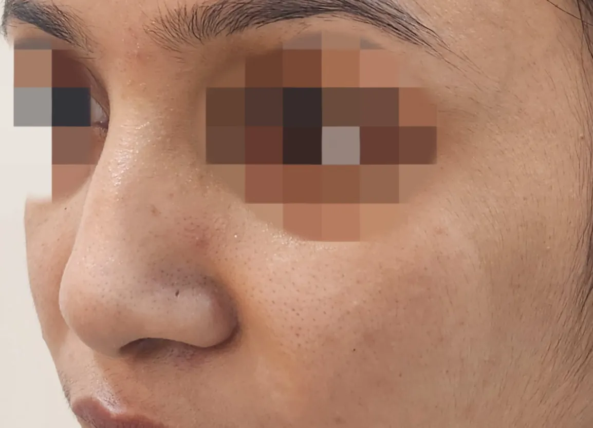 Non Surgical Rhinoplasty — after