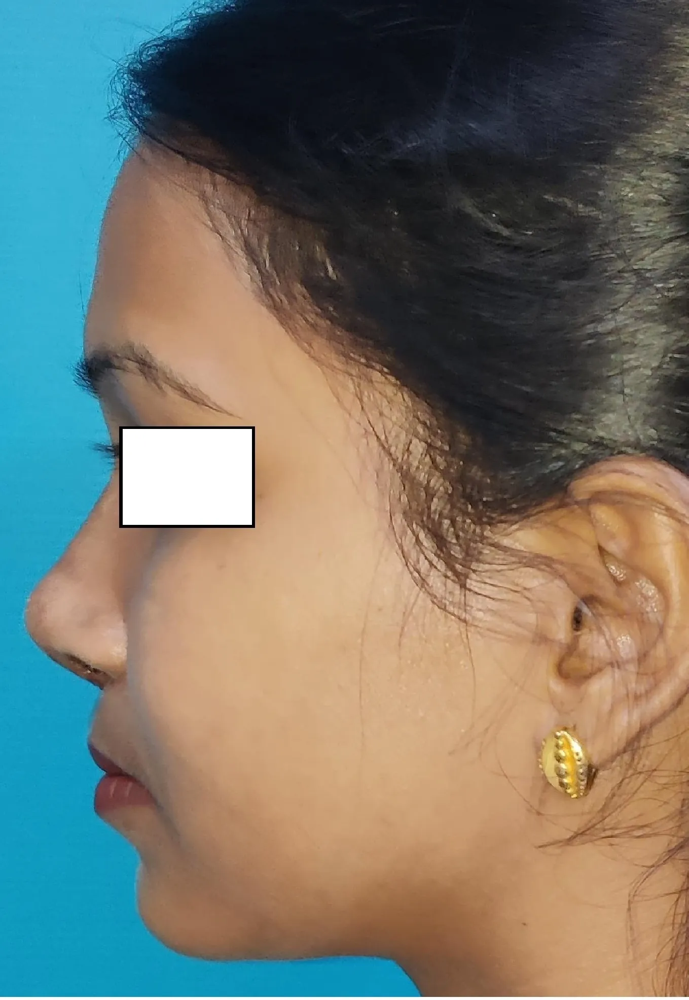 Rhinoplasty — after