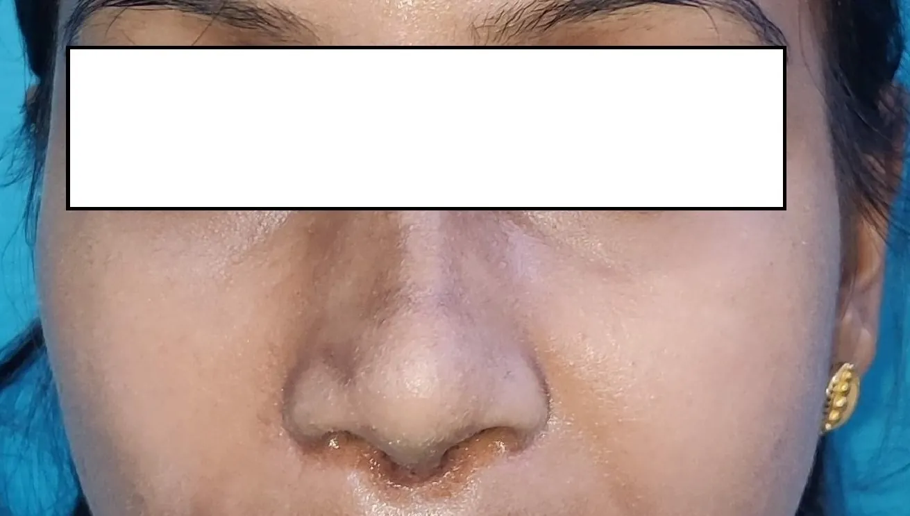 Rhinoplasty — after