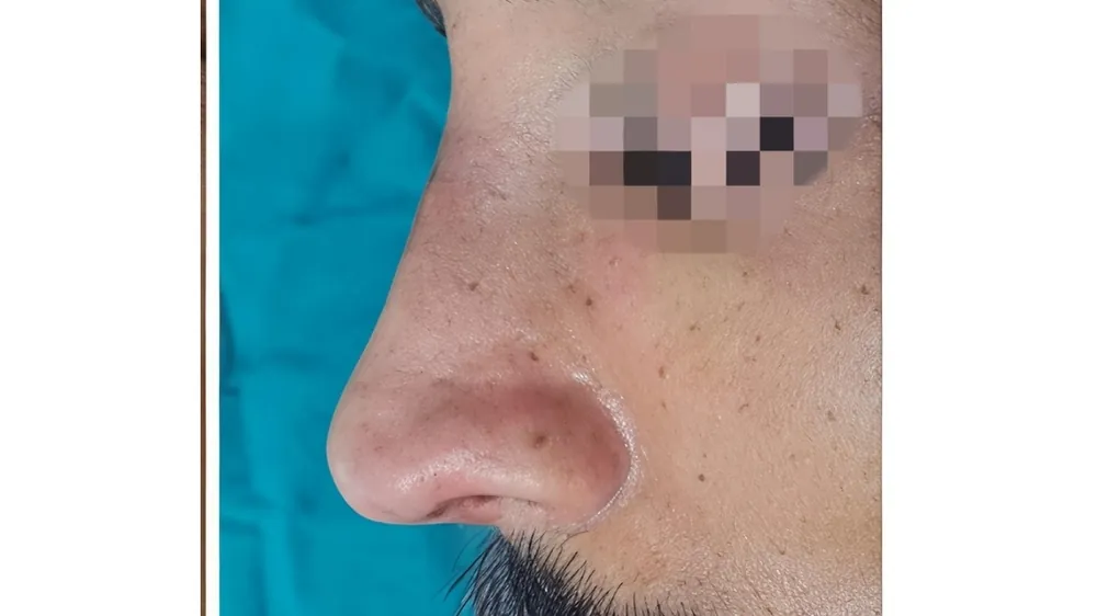 Rhinoplasty — after