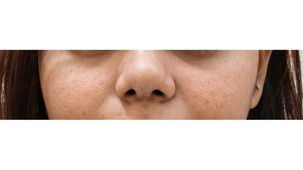 Rhinoplasty — after
