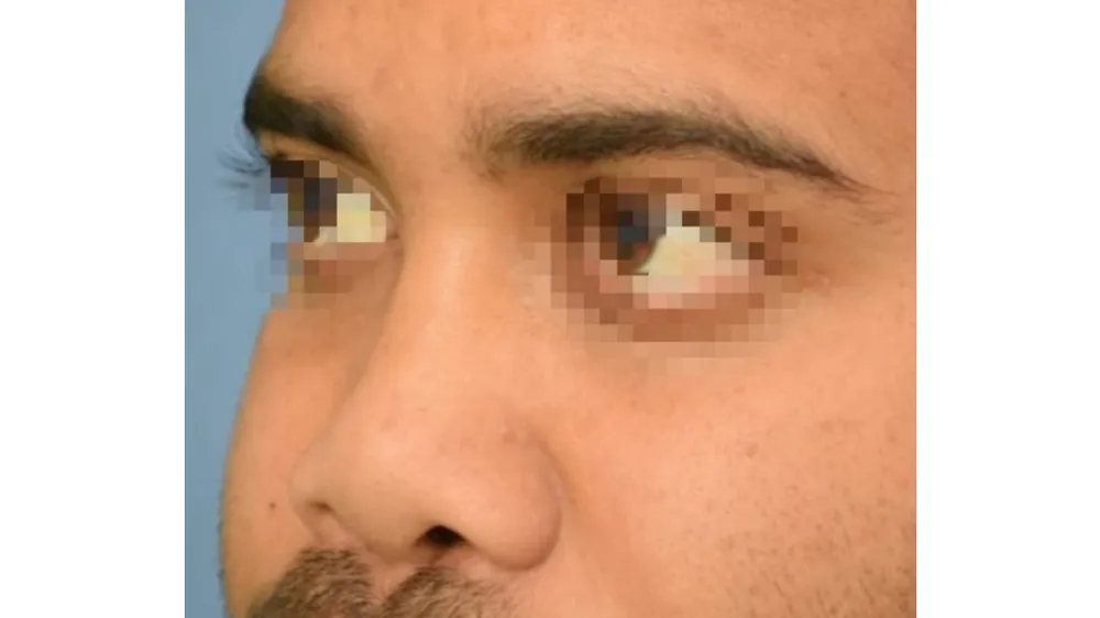 Rhinoplasty — before