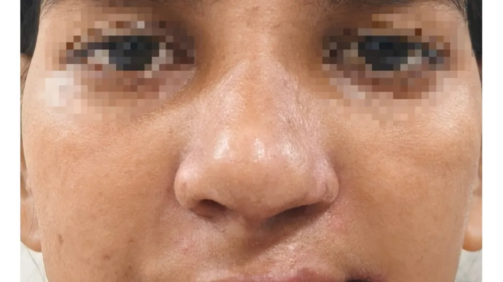 Rhinoplasty — after