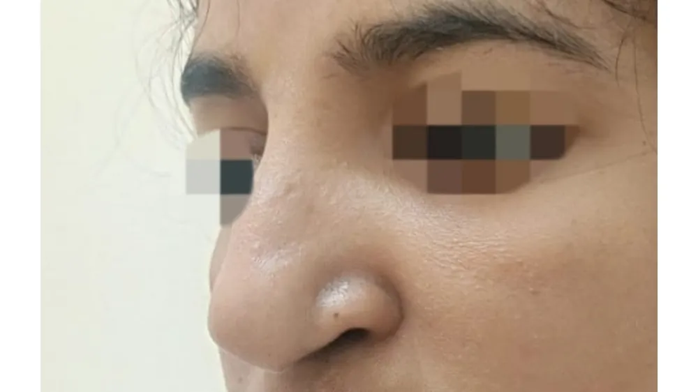 Rhinoplasty — before