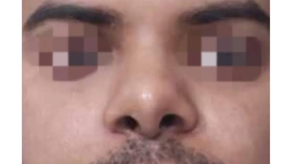 Rhinoplasty — after