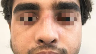 Rhinoplasty — after