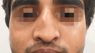 Rhinoplasty — before