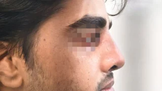 Rhinoplasty — after