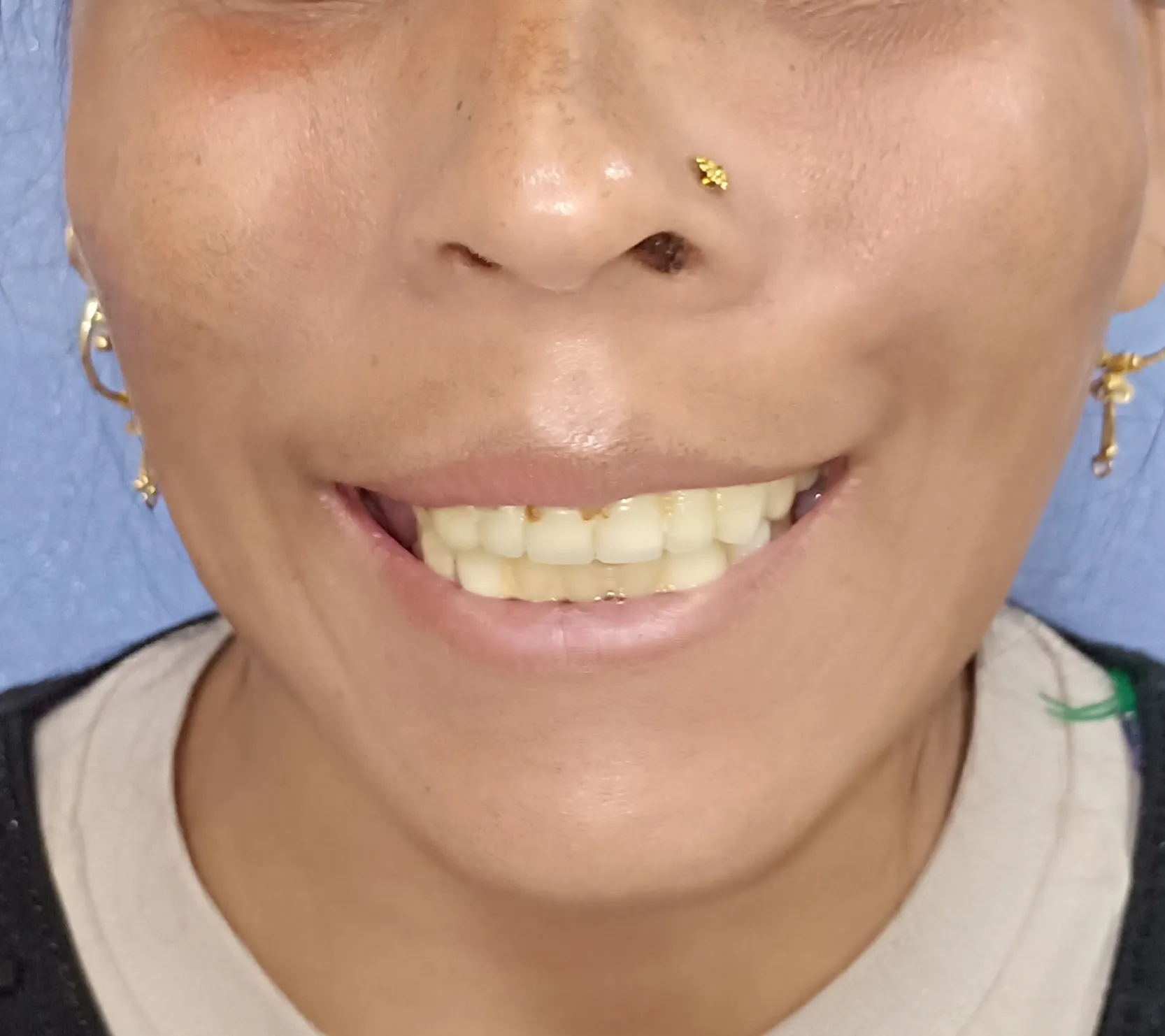 Gummy Smile Correction — after
