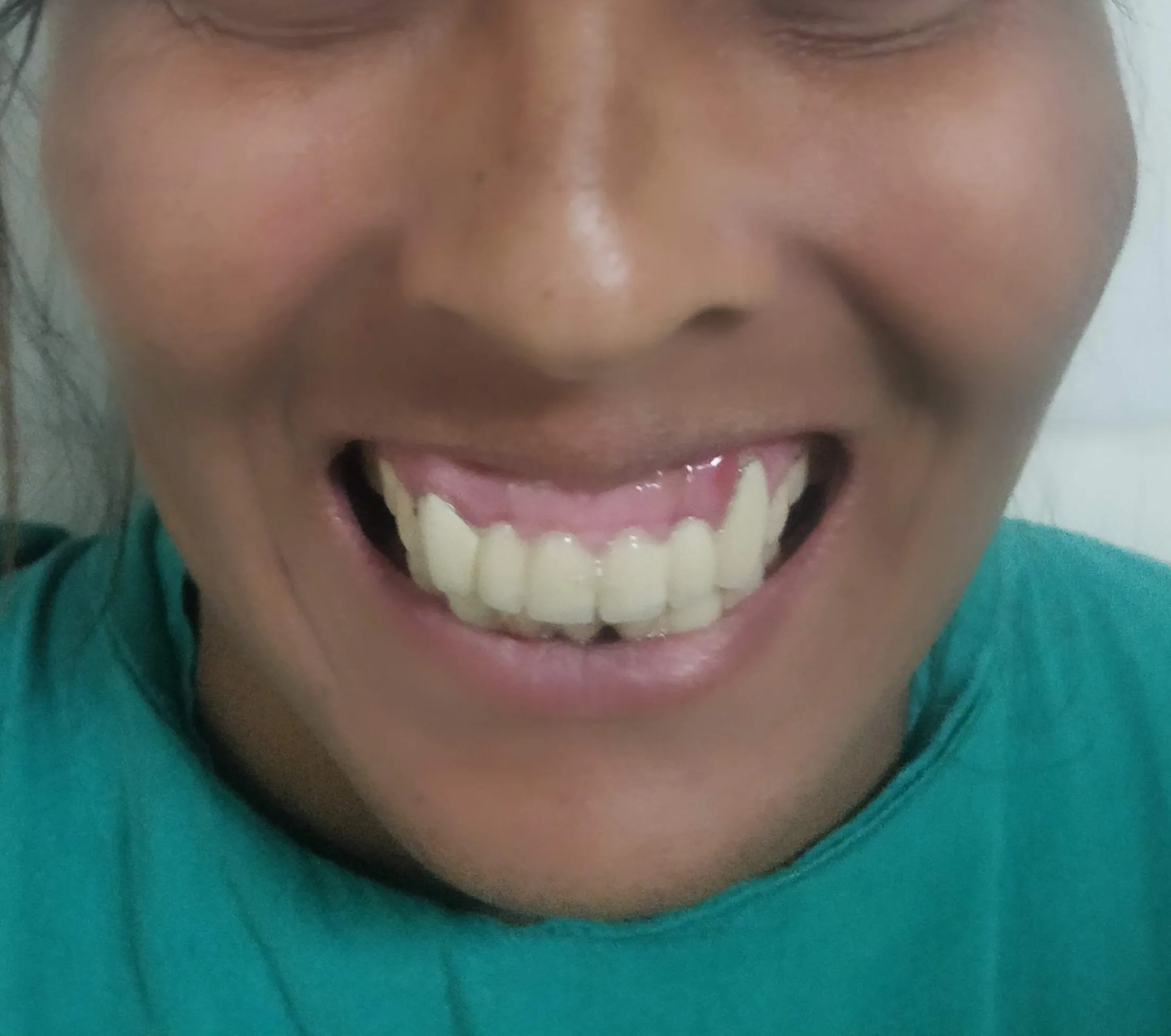 Gummy Smile Correction — before