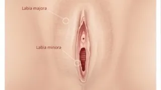 Fat Transfer To Labia Majora — after