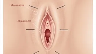 Fat Transfer To Labia Majora — before