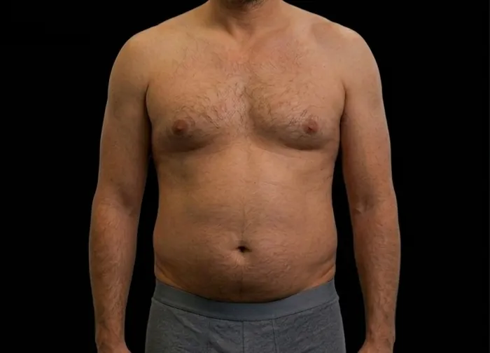 Before surgery