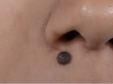 Before surgery