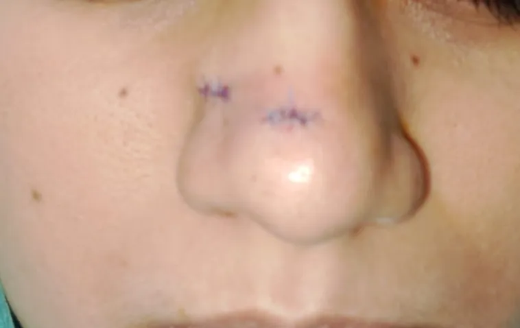 After surgery