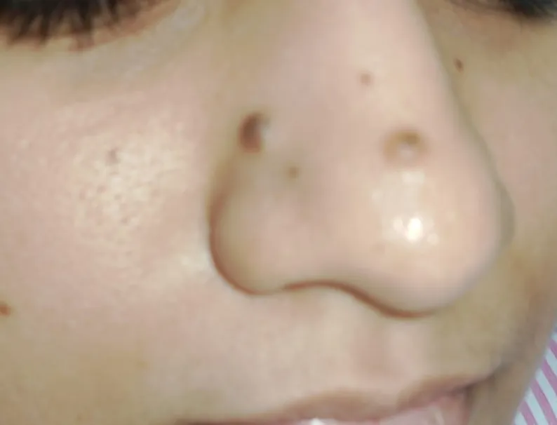 Before surgery