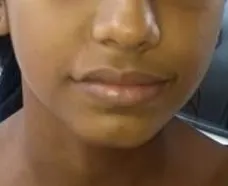 After surgery