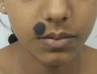 Before surgery