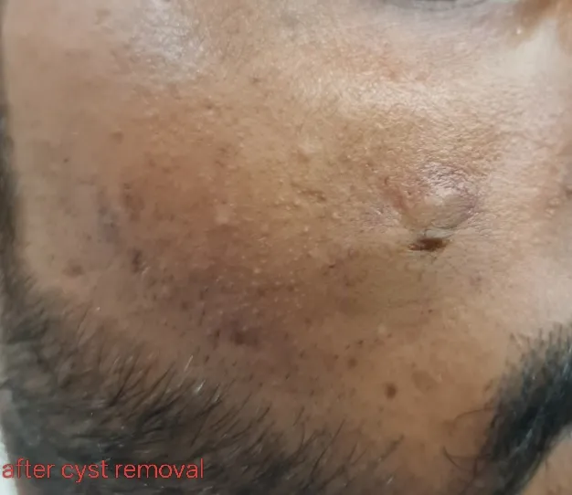 After surgery