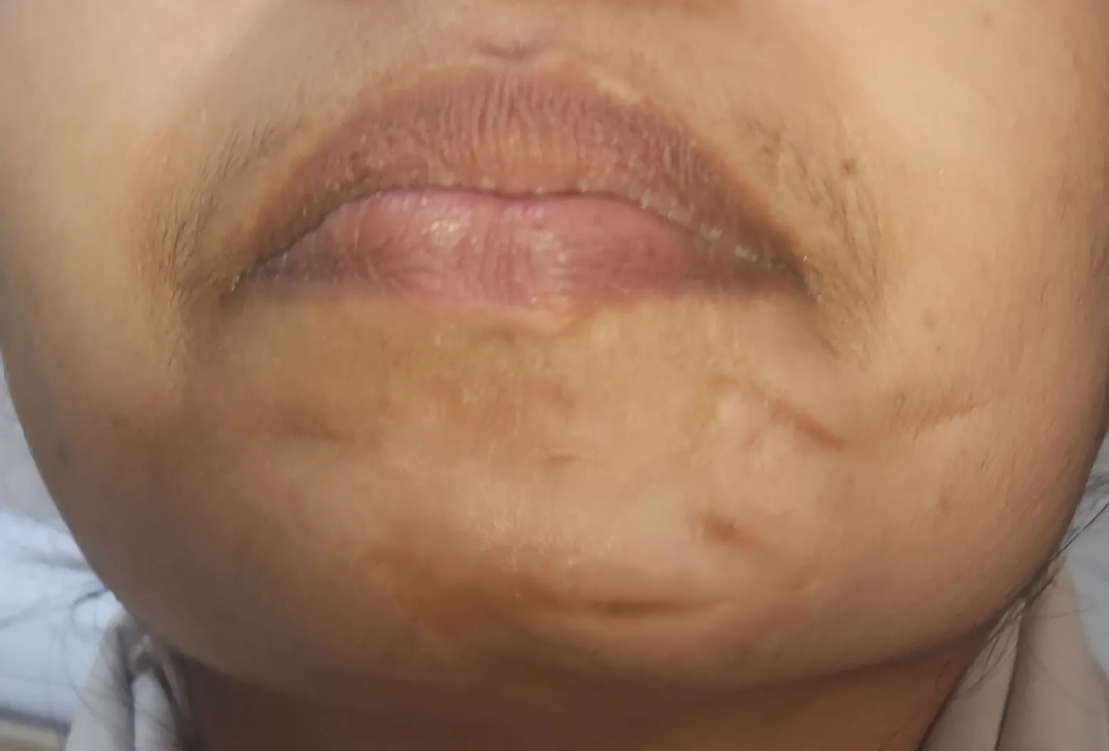 After surgery
