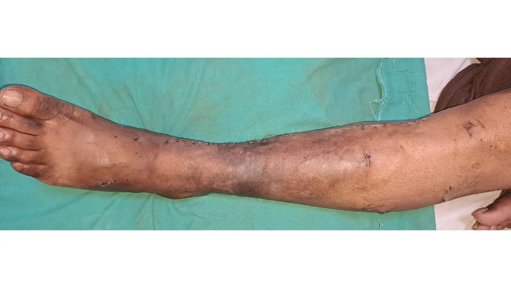 After surgery