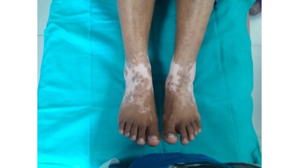 Vitiligo — before