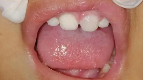 After surgery